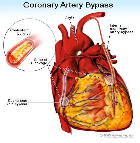 Coronary Artery Bypass Graft (CABG) Surgery, Risks, Life Expectancy