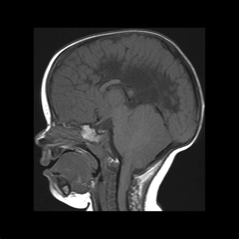 Infant status post myelomeningocele repair | Pediatric Radiology Case | Pediatric Imaging ...