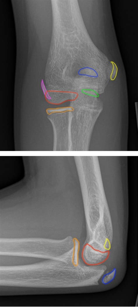 Pediatric Elbow | Radiology | U of U School of Medicine