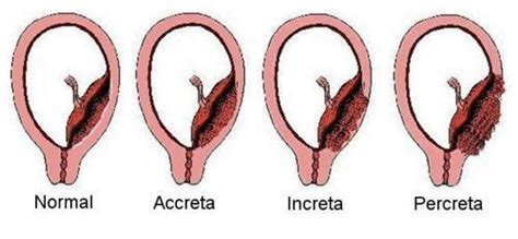 Placenta Accreta - What is, Symptoms, Risk Factors, Diagnosis