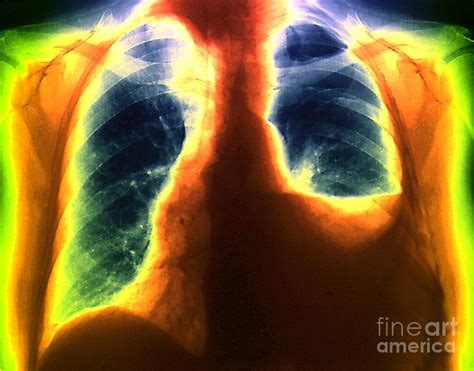 Hydropneumothorax Photograph by Zephyr/science Photo Library - Pixels