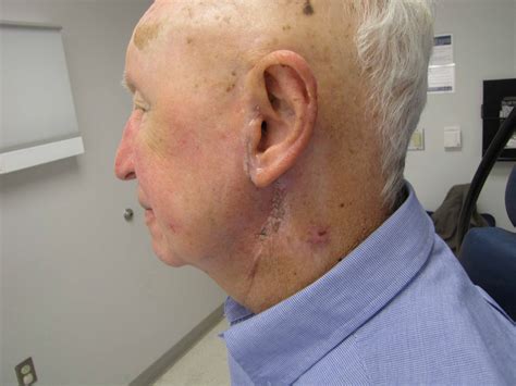 Closed Suction (Jackson Pratt) Drain Placement and Removal | Iowa Head and Neck Protocols