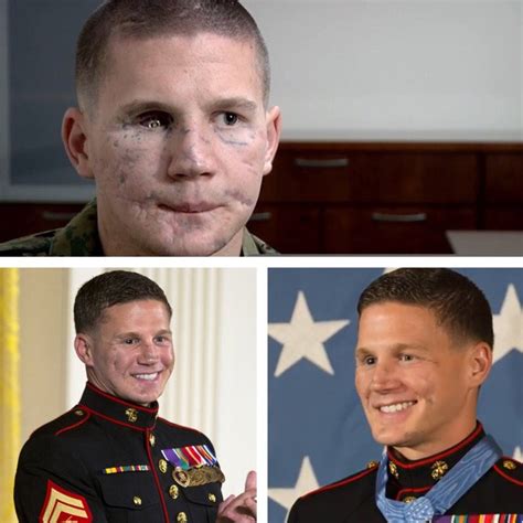 Medal Of Honor recipient Kyle Carpenter before and after facial ...