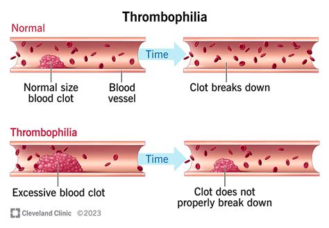 Thrombophilia: Symptoms & Treatment