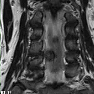 -MRI scan: Left C6 – C7 herniated disc Figure 5 -MRI scan: Left C6 – C7... | Download Scientific ...