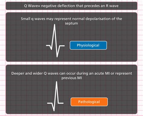 CVT Mohd Farid: ECG & Echocardiography Case Study Chronic Myocardial ...