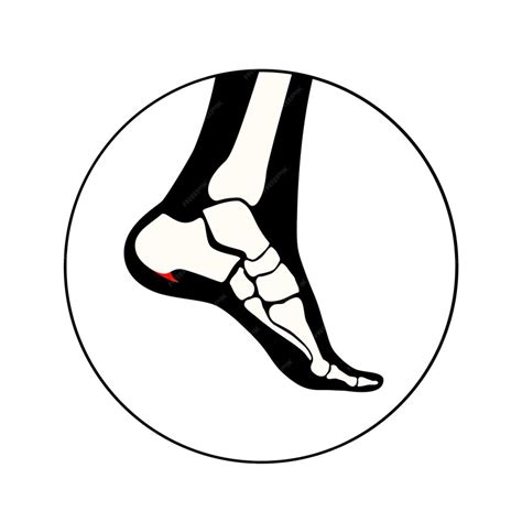 Premium Vector | Calcaneal spur icon foot problem diagnostic and treatment in a podiatry clinic ...