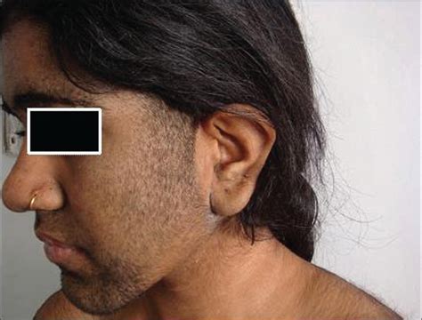 Hypertrichosis Treatment Before And After