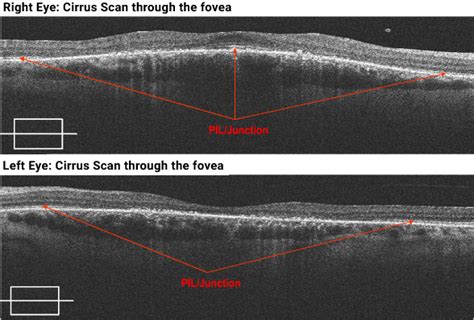 Plaquenil Induced Retinal Toxicity - Page 8 of 25 - Retina Revealed