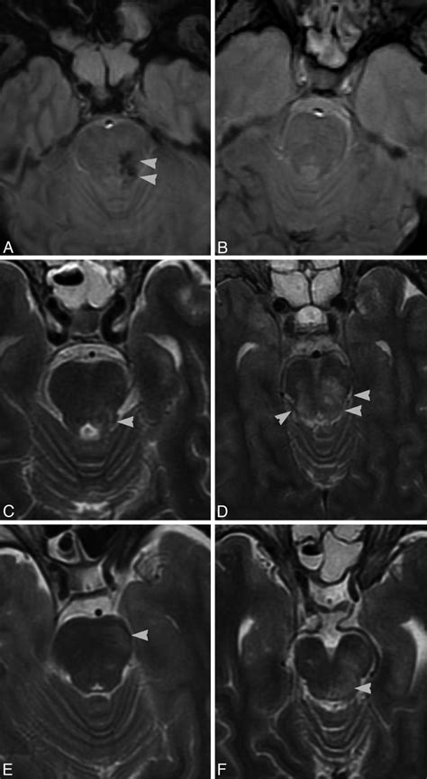 Severe Traumatic Head Injury: Prognostic Value of Brain Stem Injuries ...