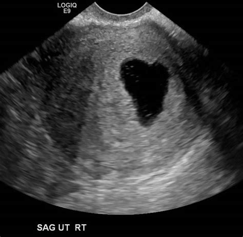 Blighted ovum definition, causes, symptoms, diagnosis & treatment