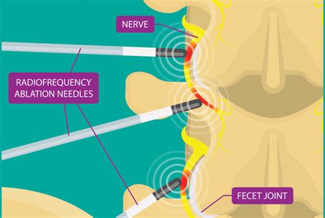 neck nerve ablation