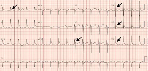 Hypothermia Ecg