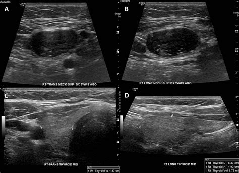 Cureus | Benign Ectopic Thyroid in the Lateral (Level II) Neck Compartment