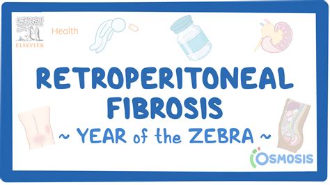 Retroperitoneal fibrosis: Video & Causes | Osmosis