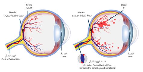 What Is Retinal Vein Occlusion | Moorfields Eye Hospital UAE