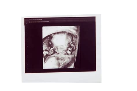 Ultrasound baby scan — Stock Photo © belchonock #146095733