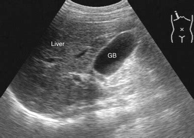 Abdominal Ultrasound Imaging: Anatomy, Physics, Instrumentation, and ...