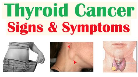 Thyroid Cancer Signs & Symptoms (& Why They Occur) - YouTube