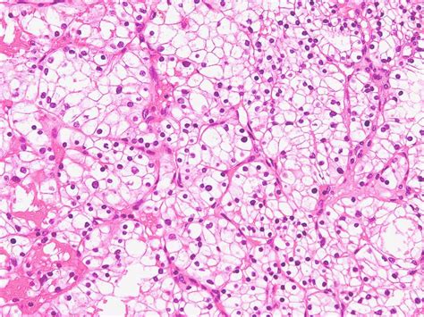 Renal Cell Carcinoma Histology