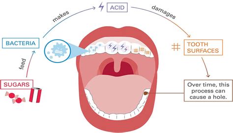 Tooth Decay Process