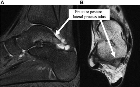 Sagittal fat-saturated proton density–weighted MR image ( A ) and axial ...