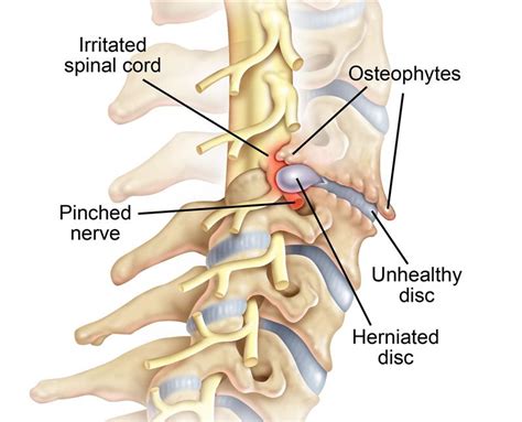 Cervical Radiculopathy Causes, Symptoms, and Treatment