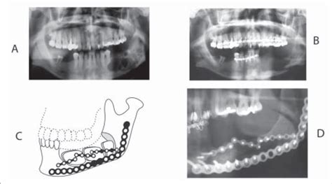 A-Preoperative panoramic radiograph view. B. Panoramic radiograph view ...