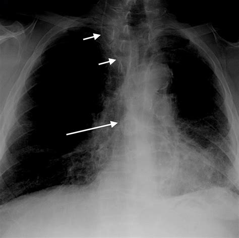 Cureus | Spontaneous Migration of a Ventriculoperitoneal Shunt into the ...