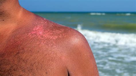How to get rid of a sunburn fast using easy at-home remedies