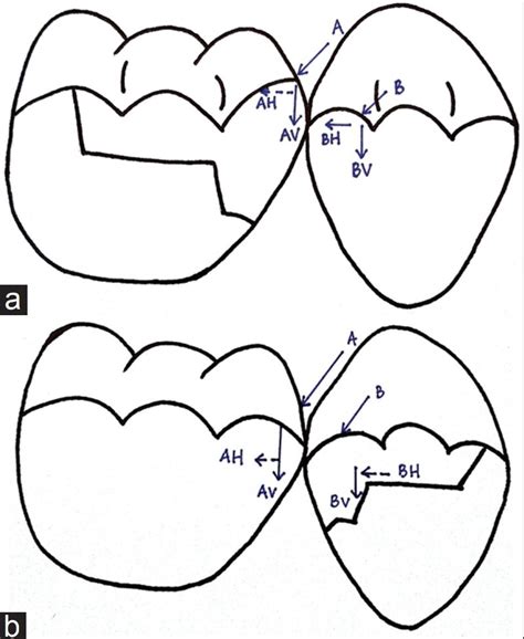 Are Marginal Ridges Marginalised In Your Restorations?