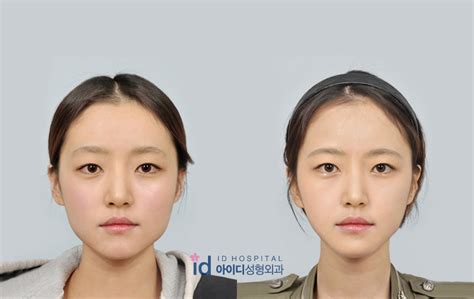 ID Hospital Korea: [ID Hospital In The News] The Secret to an Ideal V Line Face Shape is...?