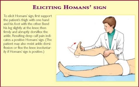 Homan sign dvt