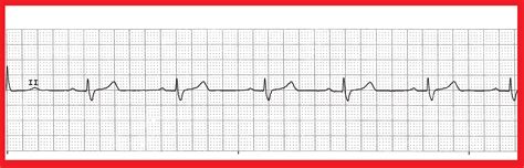 Float Nurse: Practice EKG Strips 349