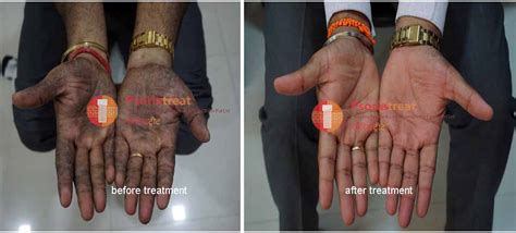 No 1 Best Plantar Psoriasis Treatment at Psoriatreat Pune India