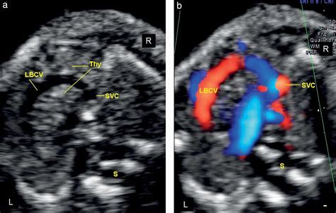 Fetal left brachiocephalic vein in normal and abnormal conditions - Sinkovskaya - 2012 ...