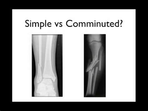 Impacted Fracture X Ray