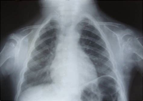 Spondyloepiphyseal Dysplasia - Dr. Vasu