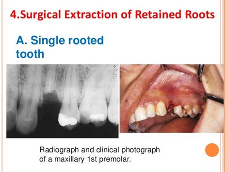 Principles and steps of surgical tooth extraction