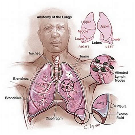 Stage Three Lung Cancer