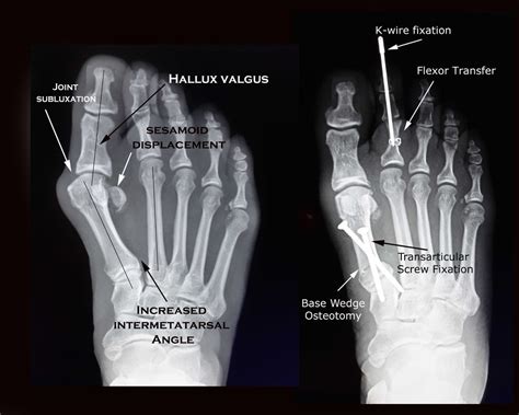 The syndesmosis bunionectomy — Bellevue Podiatric Physicians