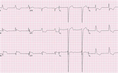 Left Bundle Branch Block - Left Bundle Branch Block