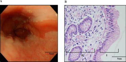 Endoscopic finding of esophagus shows irregular Z-line, elongated ...