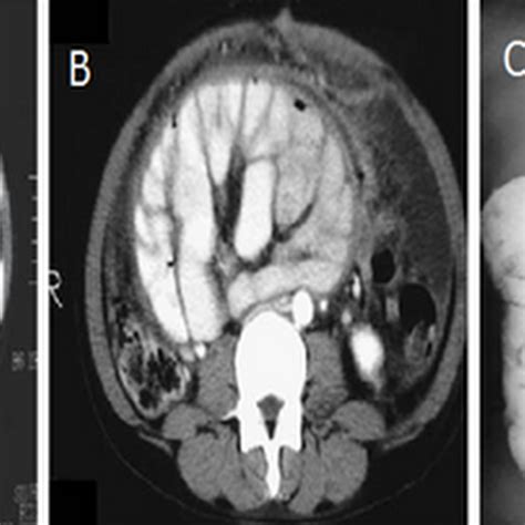 Abdominal Tuberculosis - Radiology Imaging