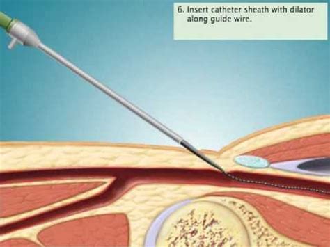 Coronary Artery Stent Placement Through Right Femoral Artery