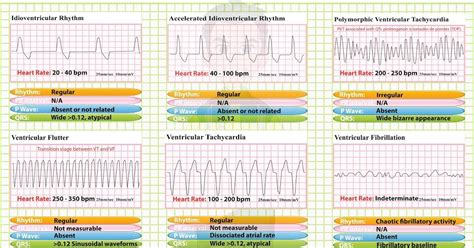 Idioventricular Rhythm Accelerated Idioventricular Rhythm Accelerated ...