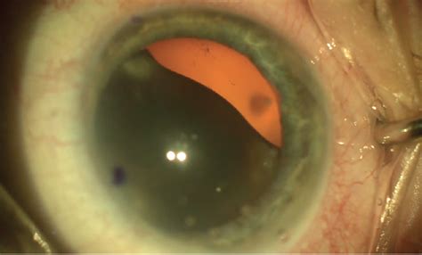 CRSToday | Dislocated Mature Black Cataract