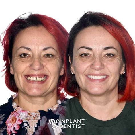 All-On-4 Dental Implants Before And After