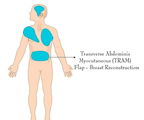 Flap Surgery - Types, Tests, Procedures and Complications