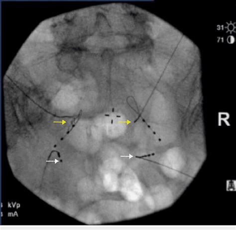 Anteroposterior fluoroscopic image of dorsal root ganglion stimulation... | Download Scientific ...